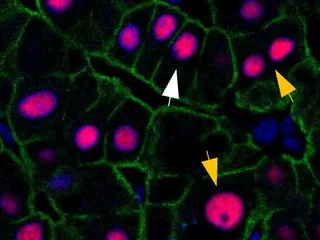 Valkoinen nuoli tässä mikroskooppikuvassa osoittaa tavalliseen maksasoluun, keltaiset nuolet soluihin joissa dna:sta on ylimääräisiä kopioita.