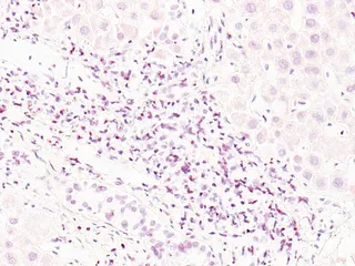 Maksan soluissa näkyvät punaiset pisteet ovat merkkejä viruksista. Ensitartunnan jälkeen viruksia voi jäädä pysyvästi elimistön kudoksiin. Virukset voivat vaikuttaa terveyteen pitkänkin ajan kuluttua vielä osin tuntemattomilla tavoilla.