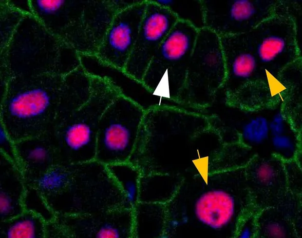 Valkoinen nuoli tässä mikroskooppikuvassa osoittaa tavalliseen maksasoluun, keltaiset nuolet soluihin joissa dna:sta on ylimääräisiä kopioita.