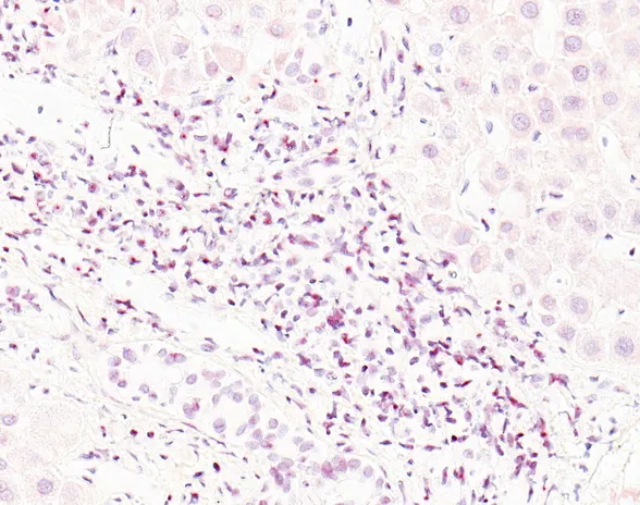 Maksan soluissa näkyvät punaiset pisteet ovat merkkejä viruksista. Ensitartunnan jälkeen viruksia voi jäädä pysyvästi elimistön kudoksiin. Virukset voivat vaikuttaa terveyteen pitkänkin ajan kuluttua vielä osin tuntemattomilla tavoilla.