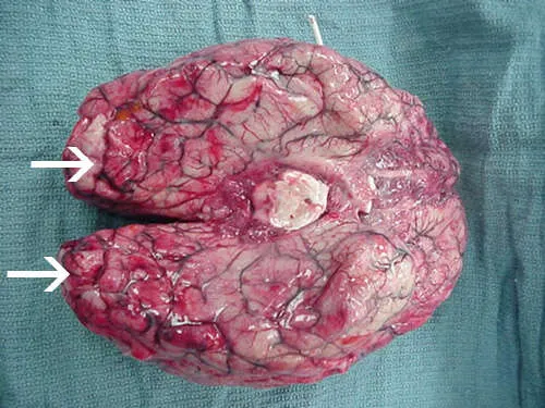 Tämä potilas ei selvinnyt. CDC:n mukaan kuvassa nuolten osoittamilla alueilla aivoihin oli syntynyt runsasta verenvuotoa ja laajoja alueita, joilla aivokudos kuoli ennen potilaan itsensä kuolemaa.