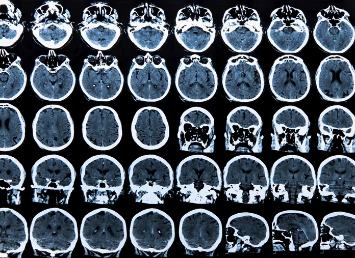 MRI-tutkimuksia pitäisi tehdä vain, kun oirekuva sitä edellyttää |  Mediuutiset